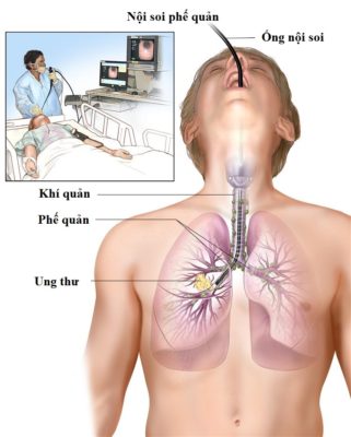 Chẩn đoán và điều trị ung thư phổi qua nội soi phế quản (1)