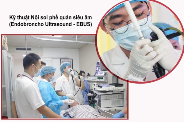 Chẩn đoán và điều trị ung thư phổi qua nội soi phế quản (3)