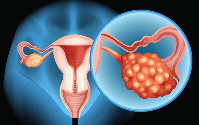 Ung thư buồng trứng phát triển từ tế bào buồng trứng