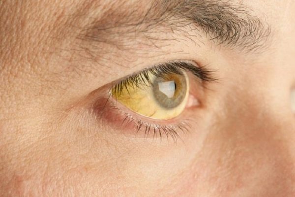 Vàng mắt, vàng da là một trong những triệu chứng điển hình của bệnh ung thư gan