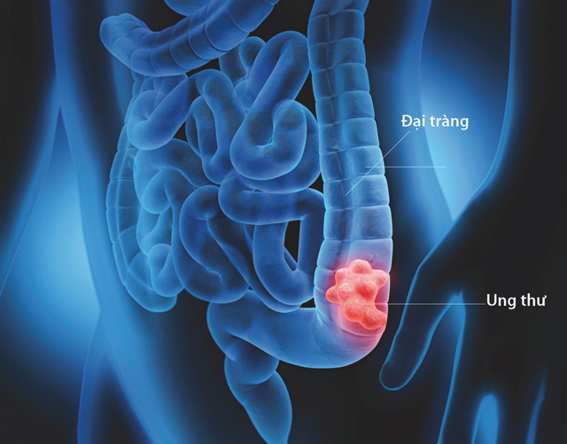Ung thư đại tràng nguyên nhân dấu hiệu triệu chứng phương pháp điều trị hiệu quả nhất (4)