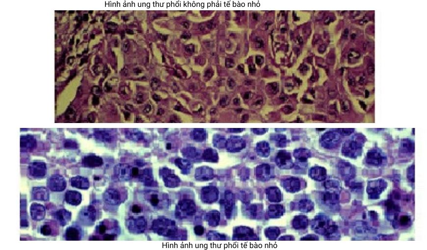 So sánh giữa ung thư phổi tế bào nhỏ và không phải tế bào nhỏ