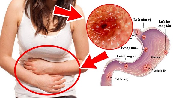 Bệnh nhân bị viêm loét dạ dày, tá tràng không được dùng Aspirin (3)