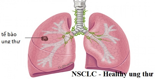 NSCLC