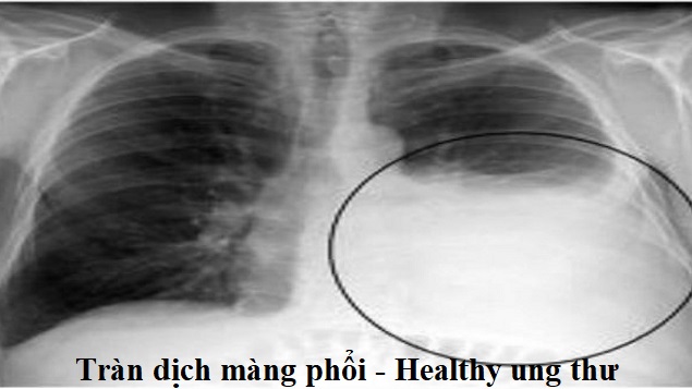 Tràn dịch màng phổi