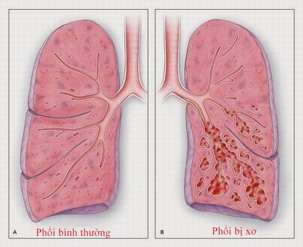 Xơ phổi